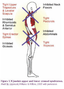 Janda Layer Syndrome Posture