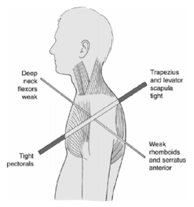 Janda Upper Crossed Syndrome