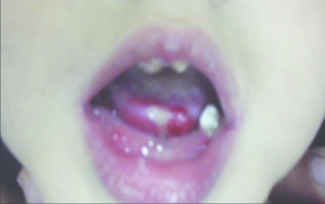 CIPA mouth ulcerations